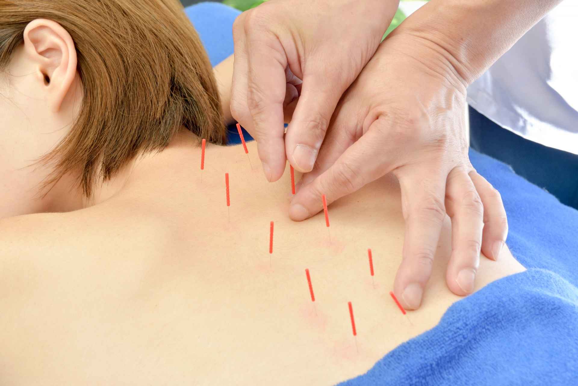 鍼灸治療【人気No.3】